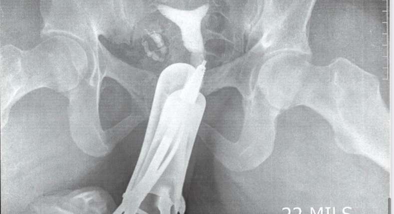 Mrs Zula's HSG image which indicates a septate uterus