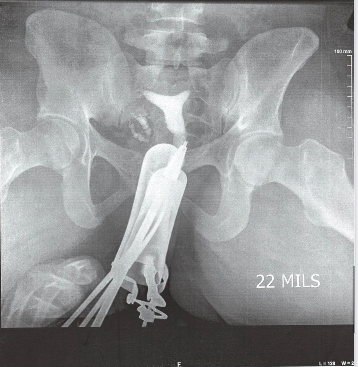 Mrs Zula's HSG image which indicates a septate uterus
